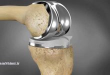 درمان شکستگی استخوان با استفاده از نانوذرات مغناطیسی